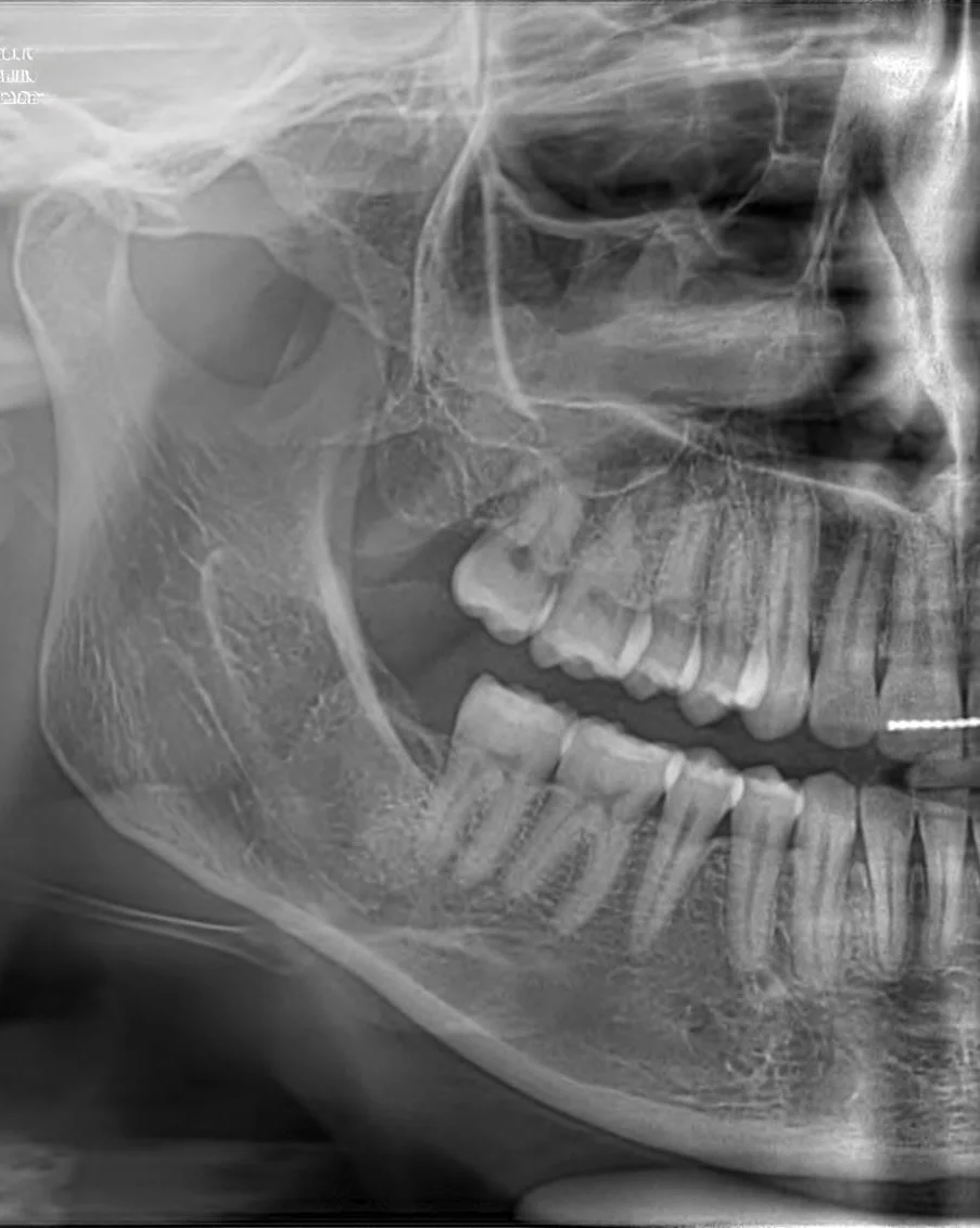Po zabiegu chirurgicznym - MEDENT Bolesławiec