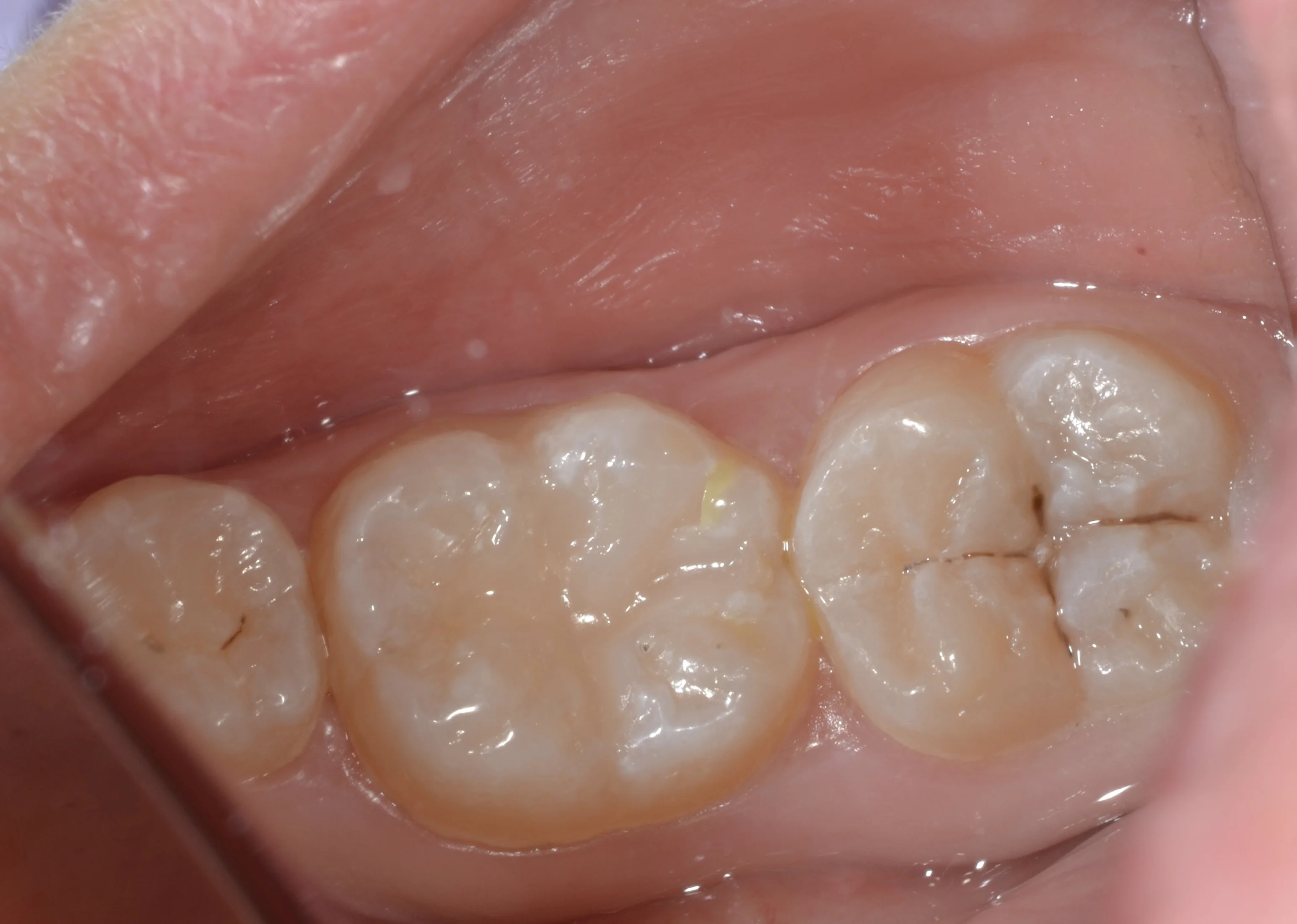 Po zabiegu - MEDENT Bolesławiec