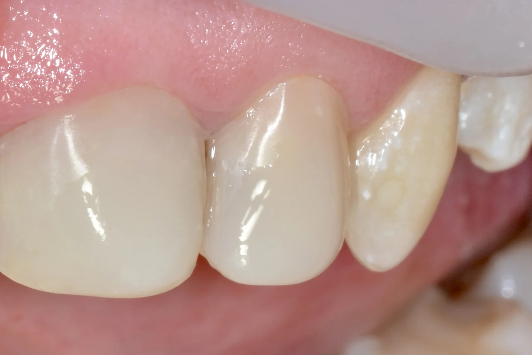 Zęby po zabiegu estetycznym - MEDENT Bolesławiec