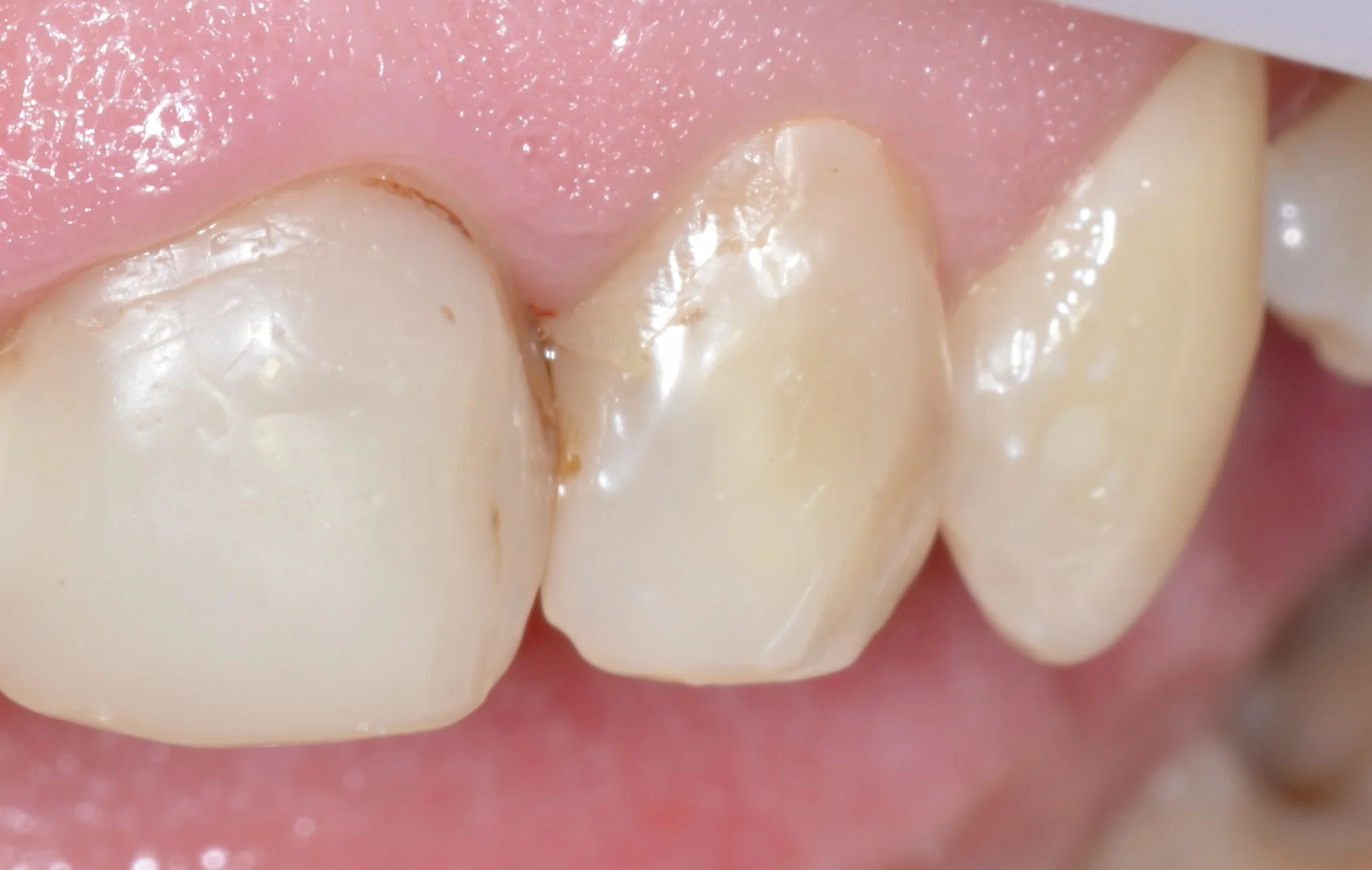 Zęby przed zabiegiem estetycznym - MEDENT Bolesławiec