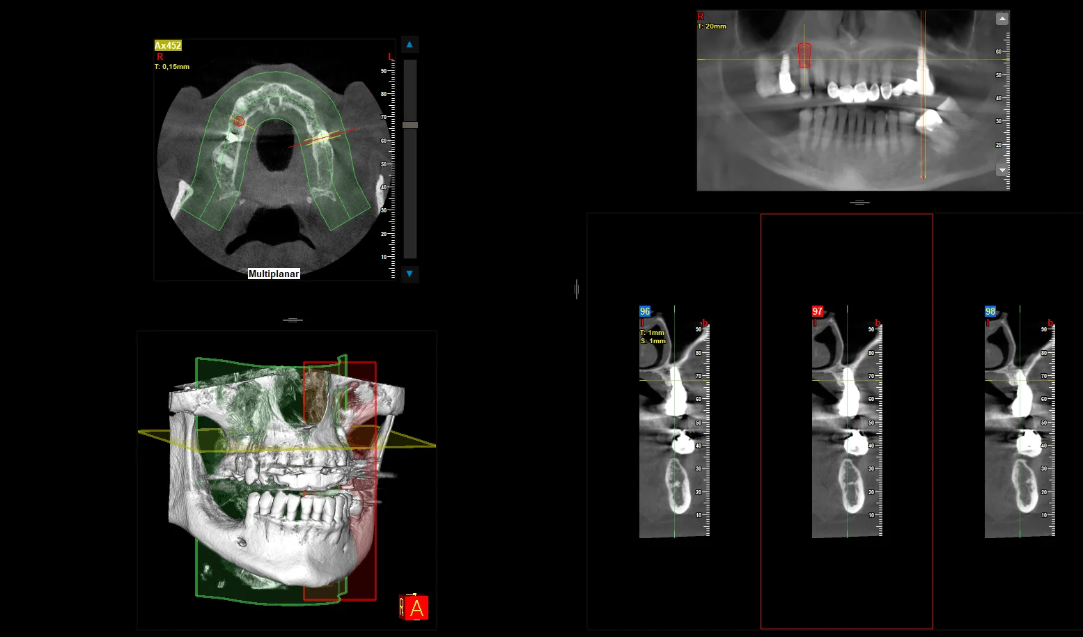Implant zębowy 3D - MEDENT Bolesławiec