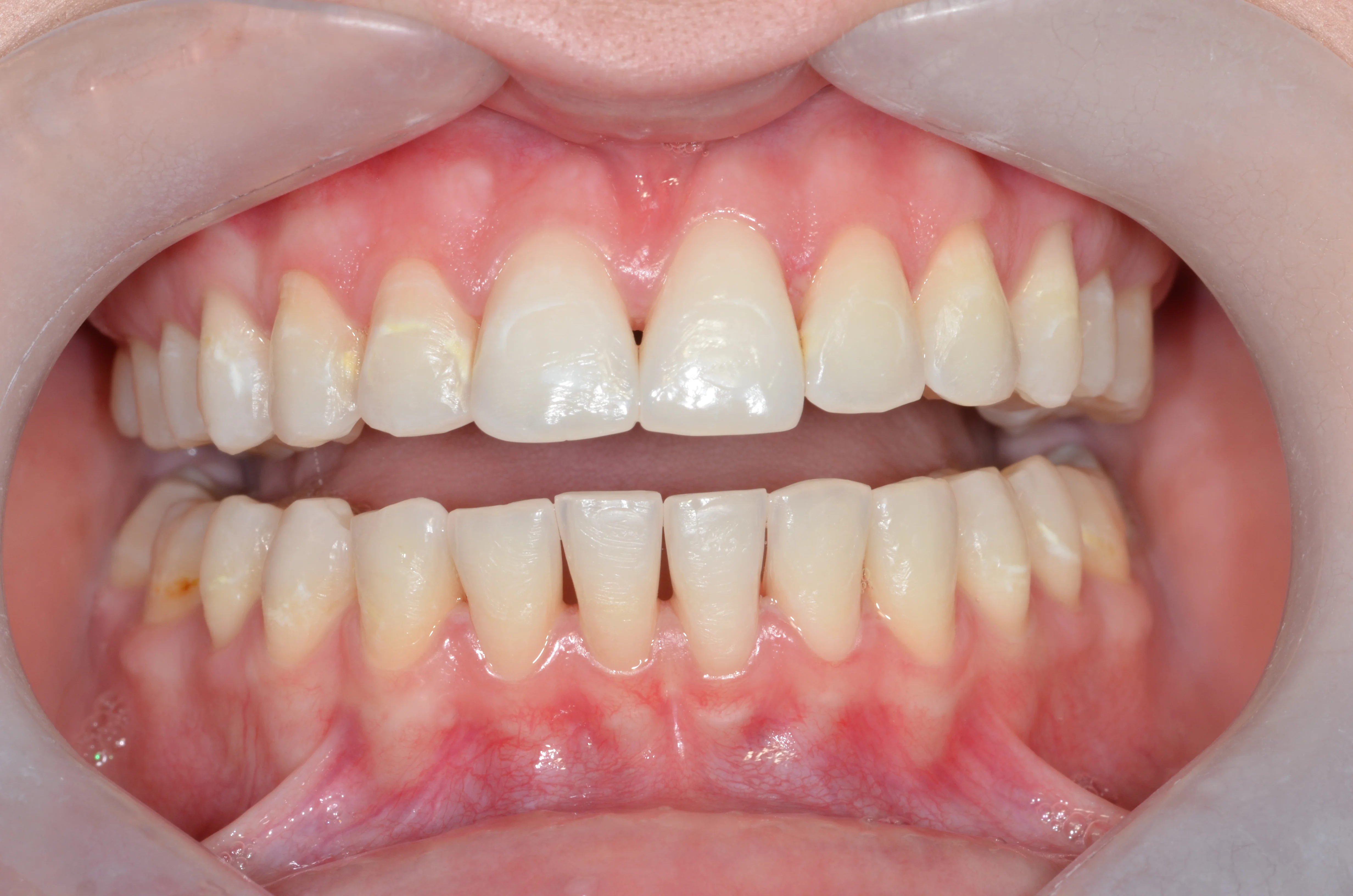 Zęby po wybielaniu - MEDENT Bolesławiec