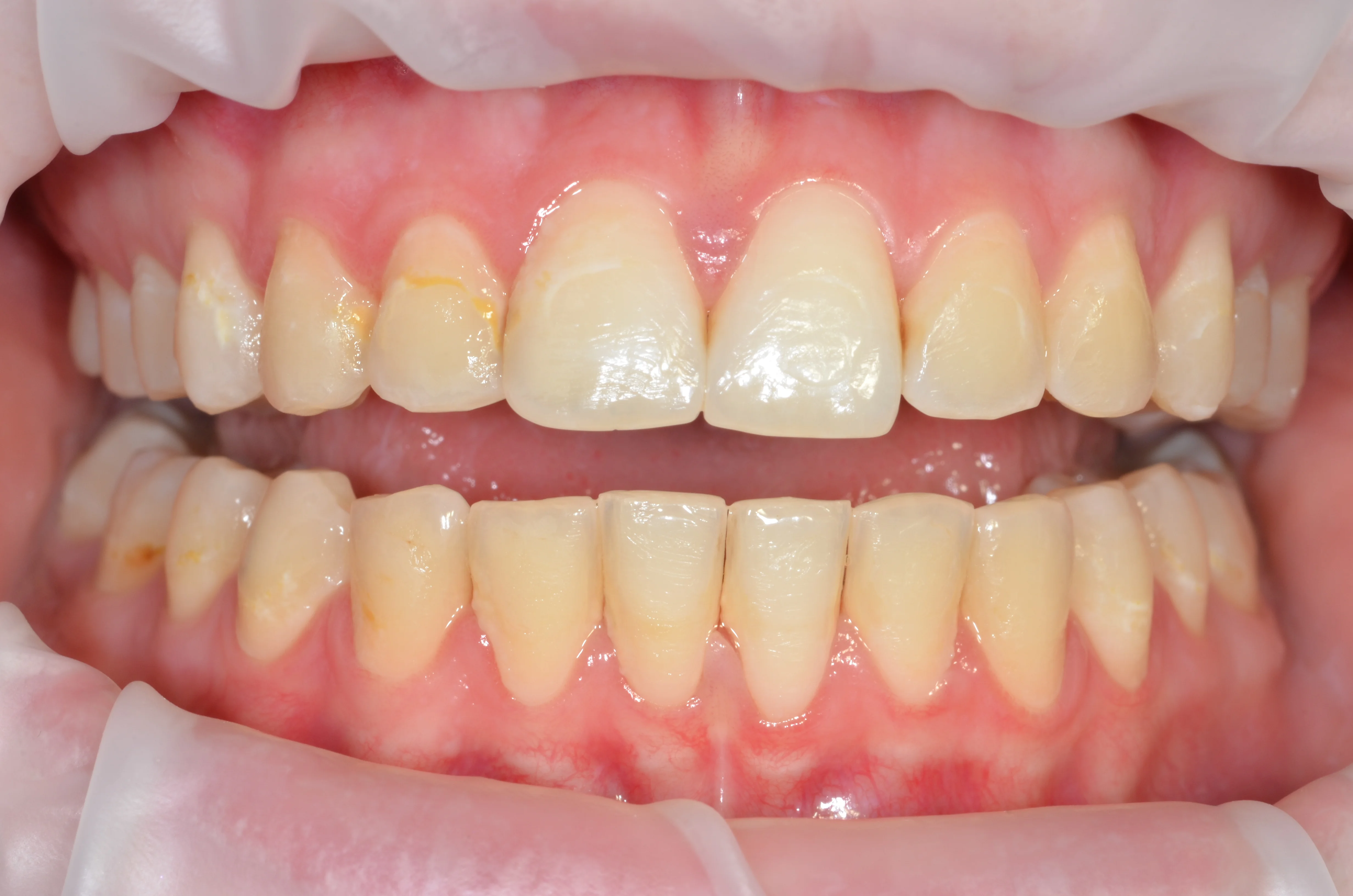 Zęby przed wybielaniem - MEDENT Bolesławiec