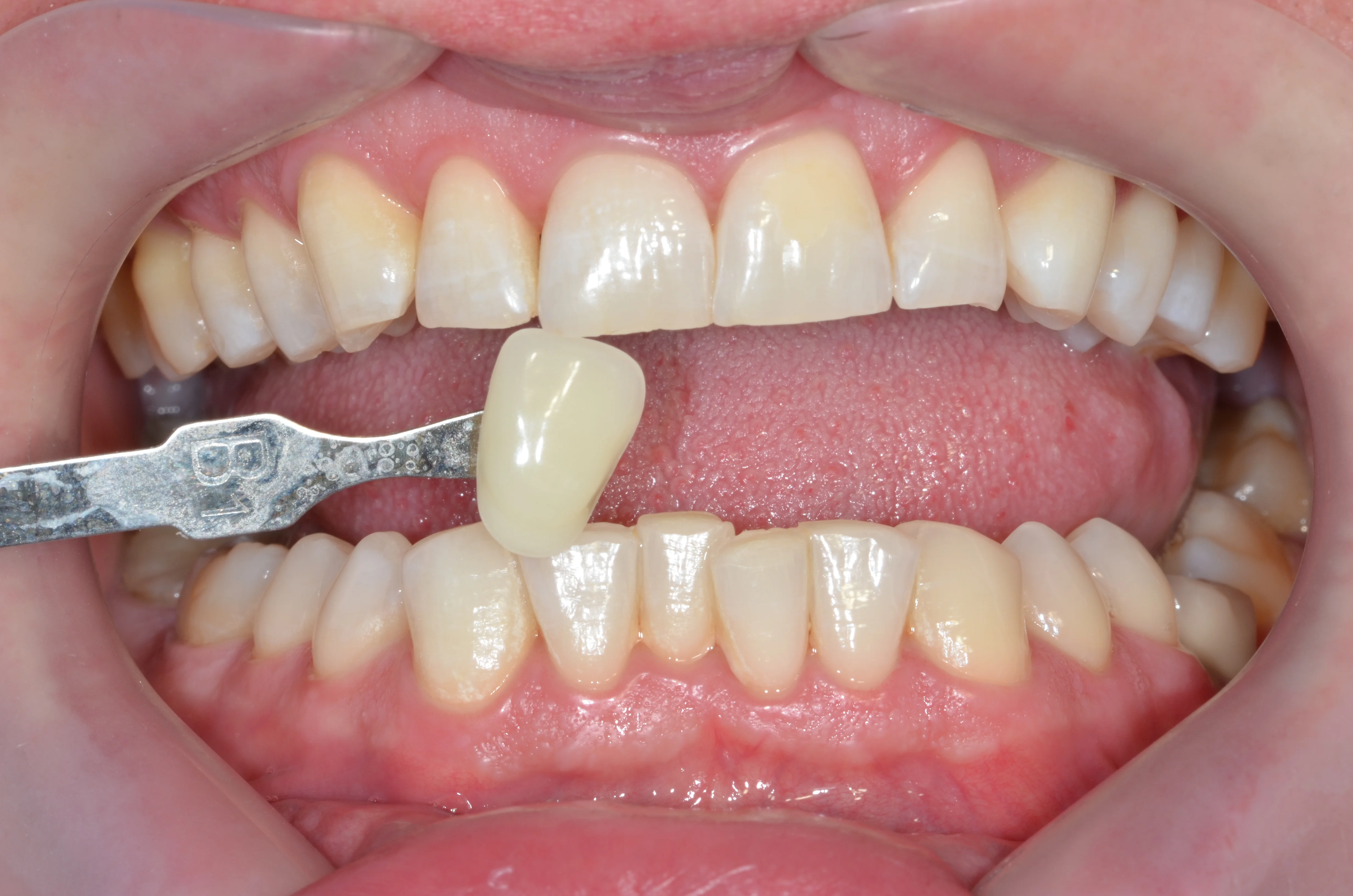 Zęby po wybielaniu - MEDENT Bolesławiec