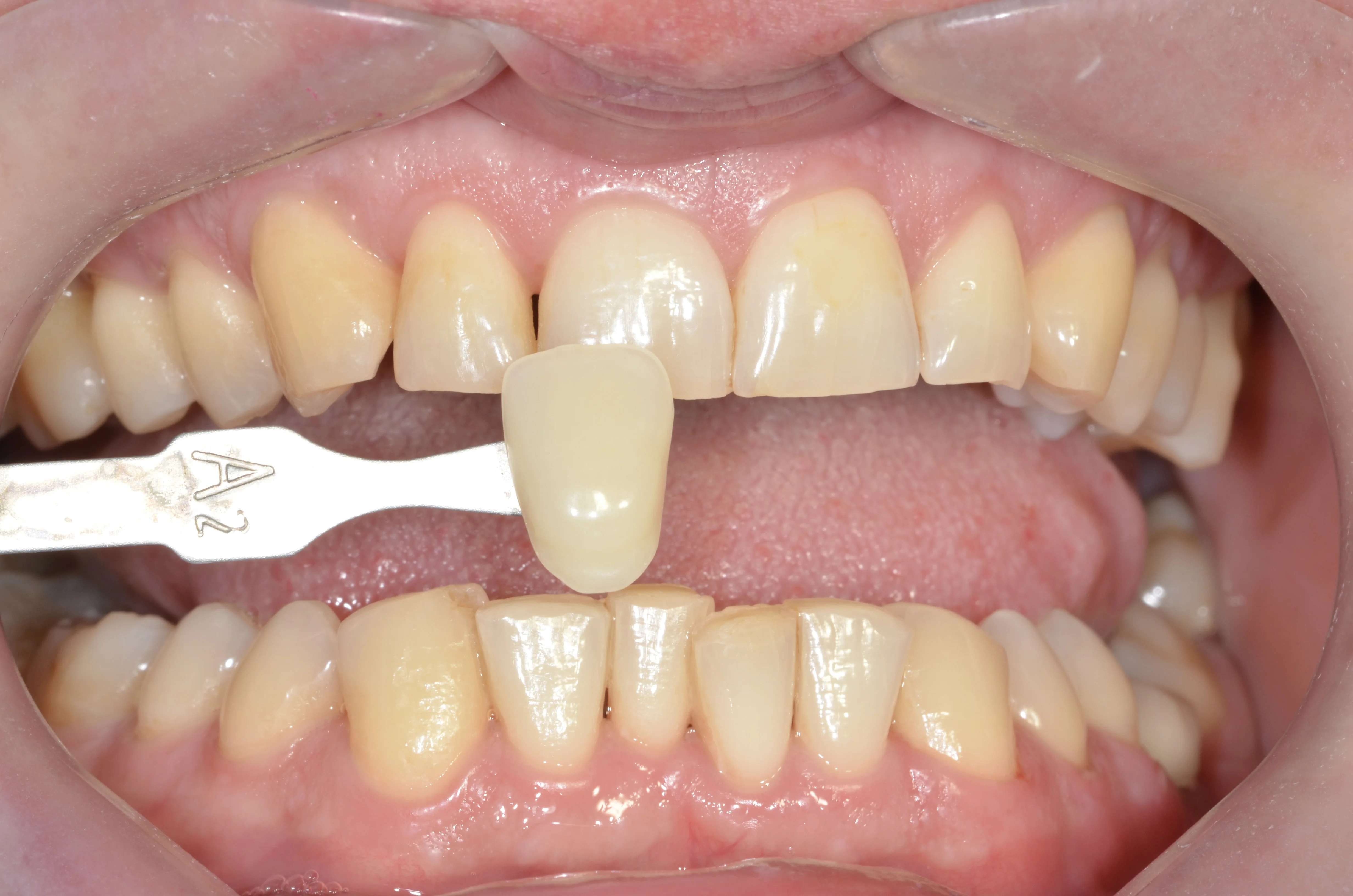 Zęby przed wybielaniem - MEDENT Bolesławiec